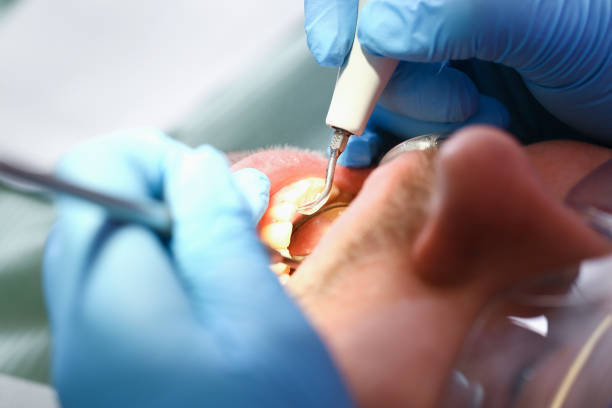 Best Emergency Dental Extractions in Bowie, TX