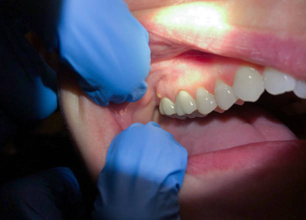 Best Emergency Dental Extractions in Bowie, TX